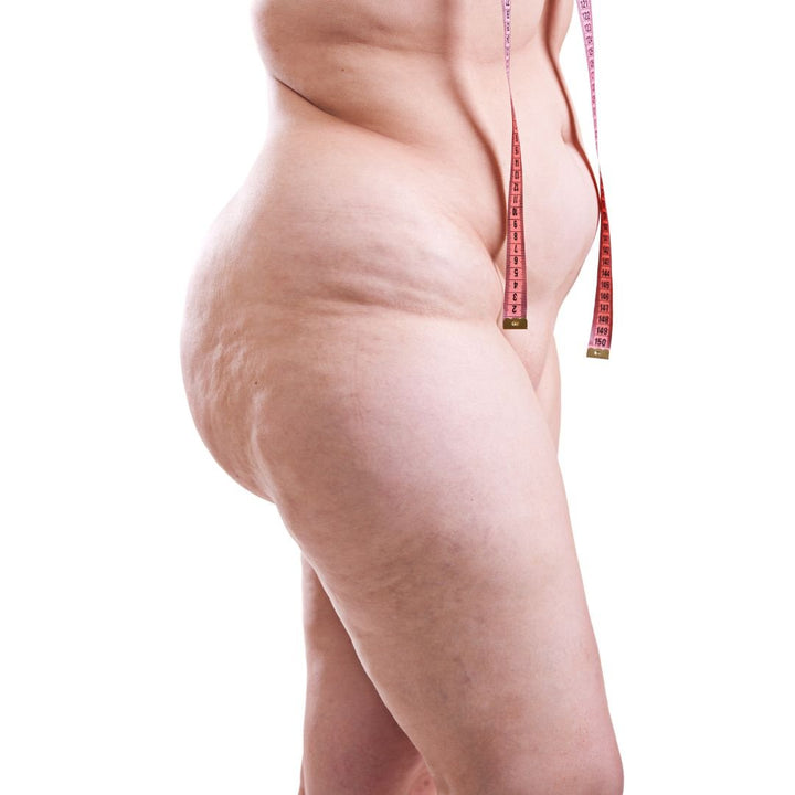 Target Areas for Ultrasonic Cavitation in Cellulite Treatment - SculptSkin