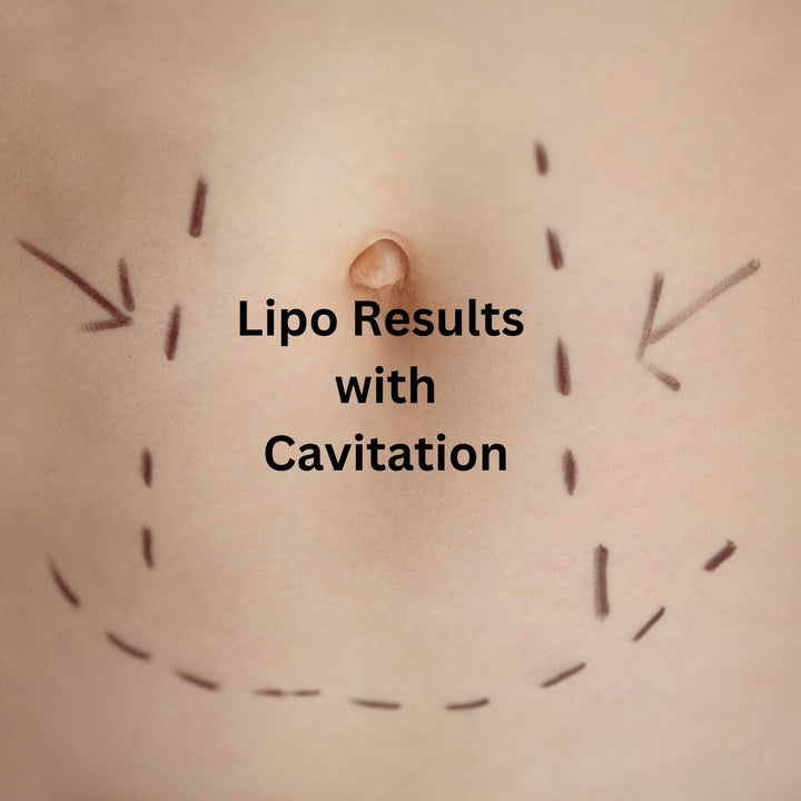 Achieving Stomach Liposuction Results with Ultrasonic Cavitation - SculptSkin