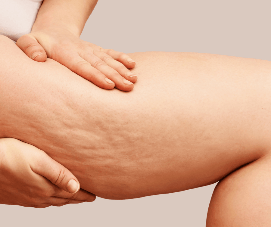 Banishing Cellulite on Legs: An Ultrasonic Cavitation and Radio Frequency Approach - SculptSkin