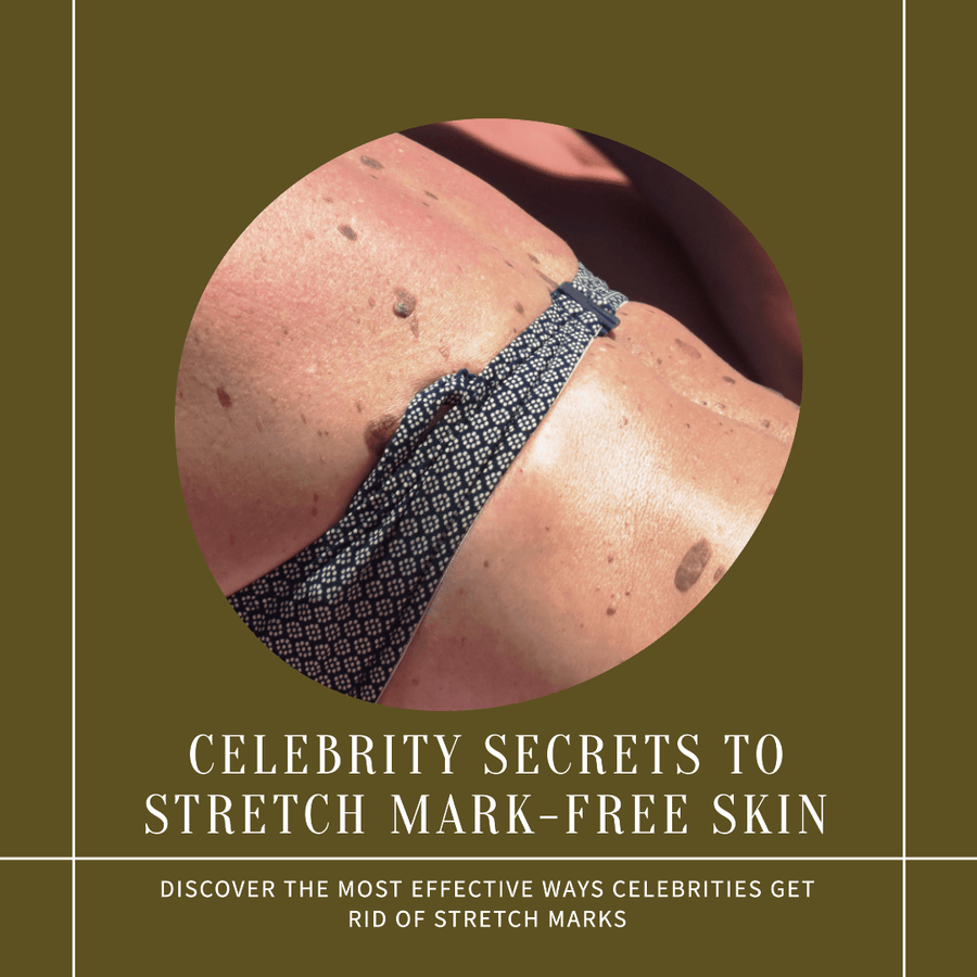 Behind the Glamour: How Celebrities Deal with Stretch Marks - SculptSkin