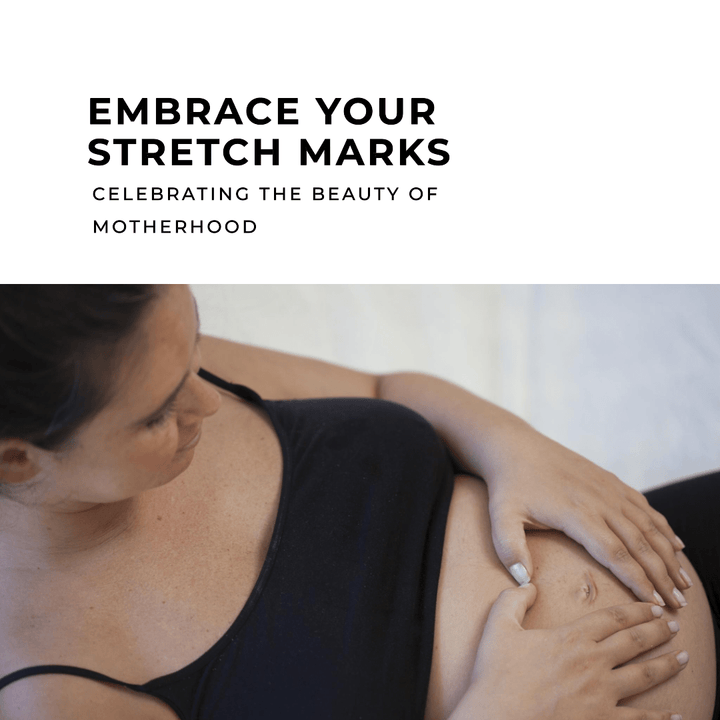 Bouncing Back: Moms Tackling Stretch Marks Head-On - SculptSkin