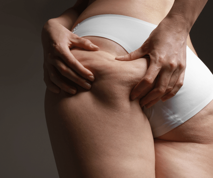 Cellulite Treatment: Conquering Cellulite with Ultrasonic Cavitation and Radio Frequency Treatments - SculptSkin