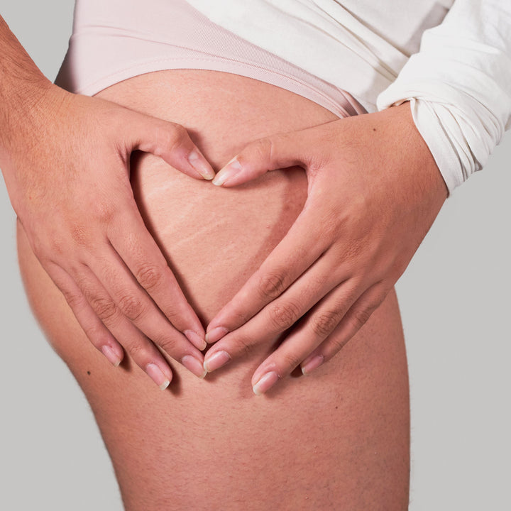 Cellulitis vs. Cellulite: Understanding the Differences, Causes, and Treatments - SculptSkin