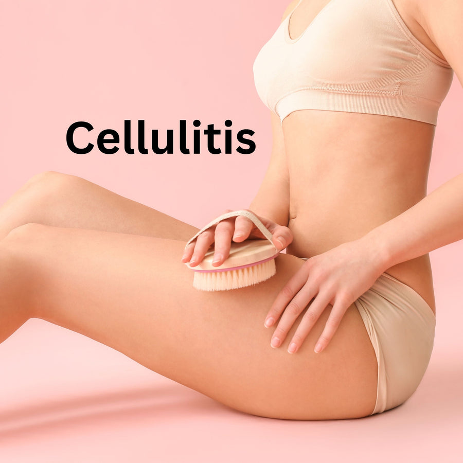 Celulitis en Niños: Síntomas, Causas y Opciones de Tratamiento - SculptSkin