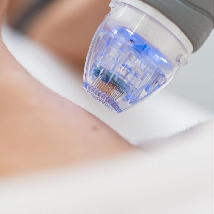 Collagen Boost: Using Microneedling to Reduce Stretch Marks - SculptSkin