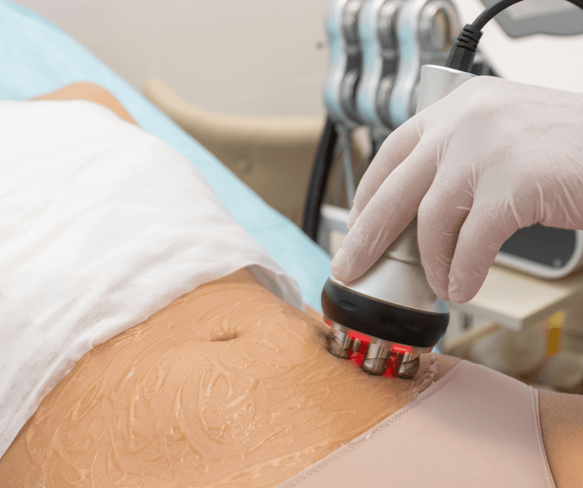 Combining Radio Frequency and Cavitation Treatments for Enhanced Body