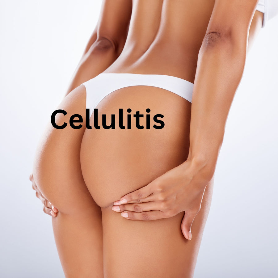 Cómo el Ejercicio Puede Ayudar con la Celulitis: Consejos de Fitness para una Piel Más Lisa - SculptSkin