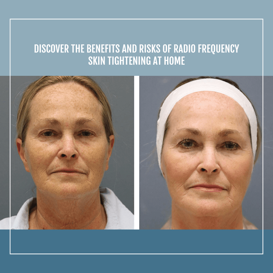 Discover the Benefits and Risks of Radio Frequency Skin Tightening at Home - SculptSkin