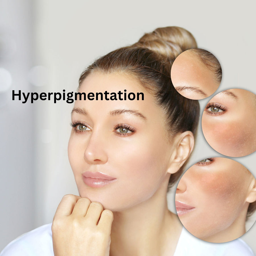 Exploring Noninvasive Treatments for Hyperpigmentation - SculptSkin