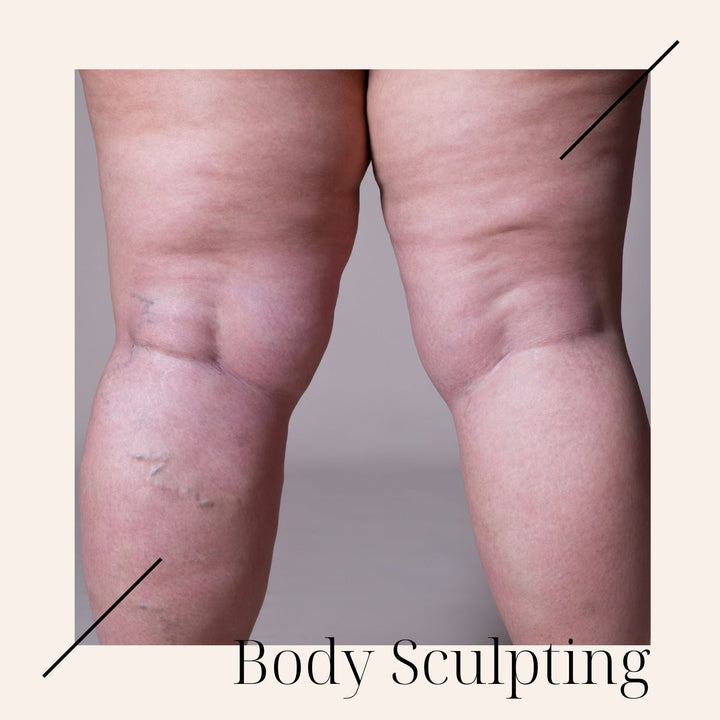 How to Get Rid of Stretch Marks on the Tummy with Ultrasonic Cavitation and Radio Frequency: The Ultimate Guide - SculptSkin