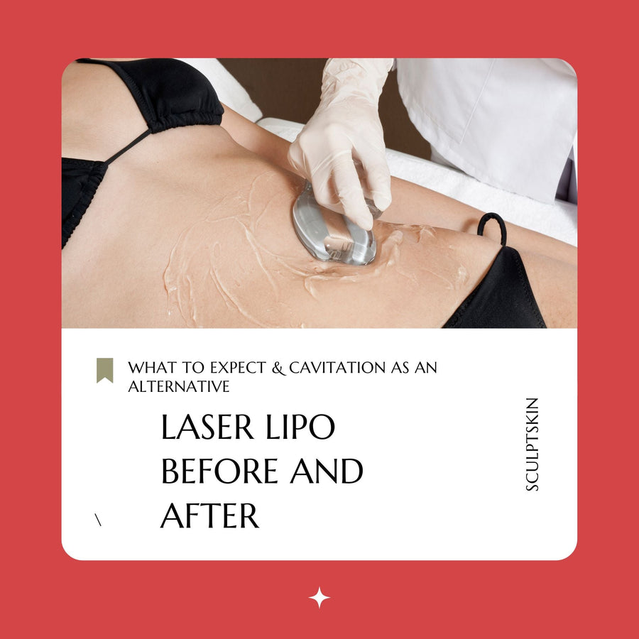 Laser Lipo Before and After: What to Expect & Cavitation as an Alternative - SculptSkin