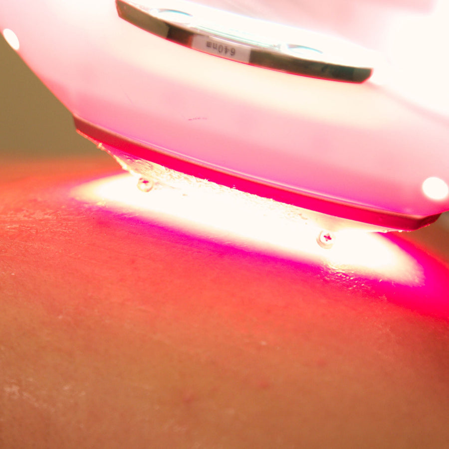 Laser Therapy for Stretch Marks: Understanding Your Options - SculptSkin