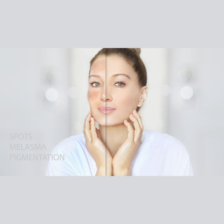 Noninvasive Treatments for Addressing Pigmentation and Dark Spots - SculptSkin