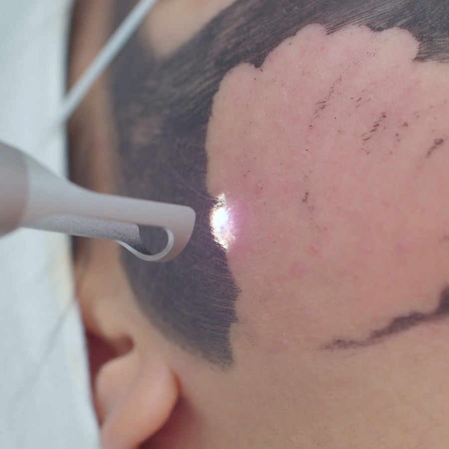 Pulsed Dye Laser: A Solution for Newer Stretch Marks - SculptSkin