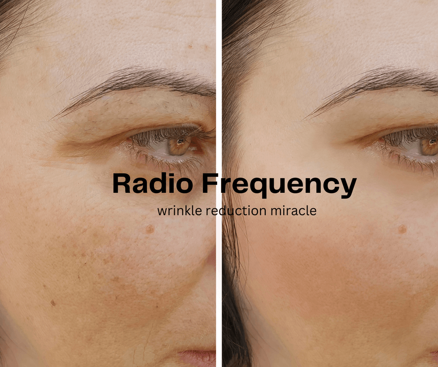 Radio Frequency for Wrinkle Reduction: What to Expect - SculptSkin ultrasonic cavitation radio frequency skin tightening body sculpting machine fat reduction cellulite stretchmark skin tightening device machine 