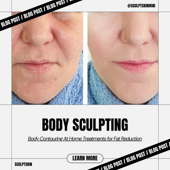 RF Treatment for Double Chin: What to Expect and How to Get the Best Results - SculptSkin