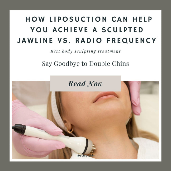 Say Goodbye to Double Chins: How Liposuction Can Help You Achieve a Sculpted Jawline vs. Radio Frequency - SculptSkin