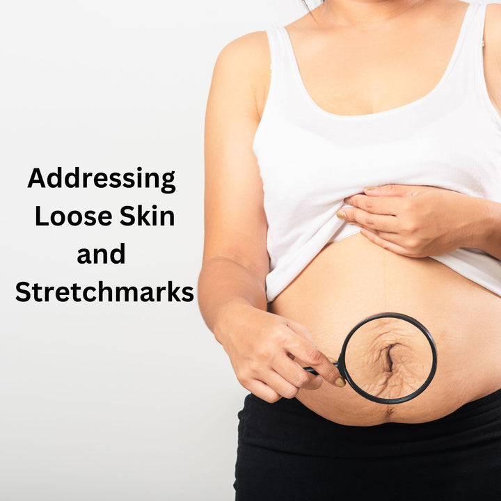 Ultrasonic Cavitation and Skin Health: Addressing Loose Skin and Stretch Marks - SculptSkin