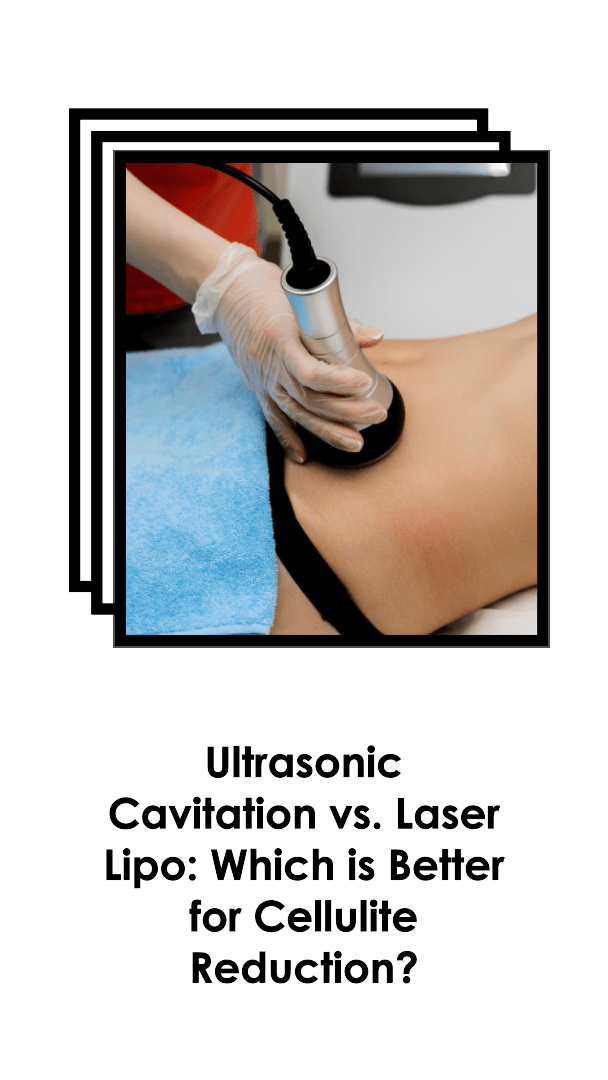 Ultrasonic Cavitation vs. Laser Lipo for Cellulite Reduction: Which Is Best? - SculptSkin