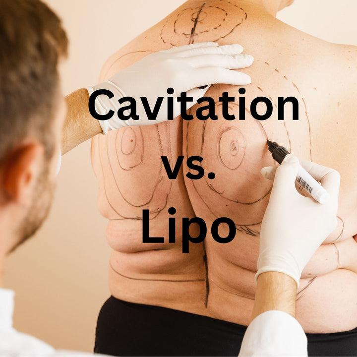 Ultrasonic Cavitation vs. Traditional Liposuction: Which Is Right for You? - SculptSkin