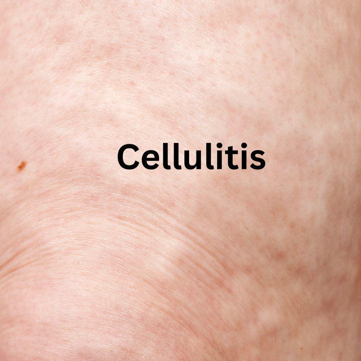 Understanding Cellulitis: Causes, Treatment Options, and the Power of Radio Frequency Skin Tightening - SculptSkin