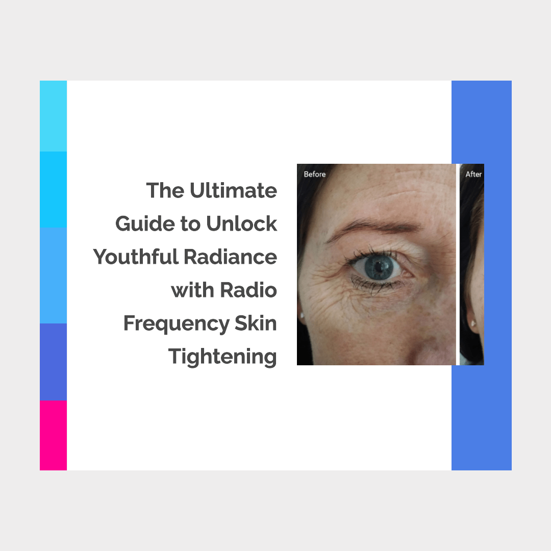 Unlock Youthful Radiance with Radio Frequency Skin Tightening: The Ult – SculptSkin