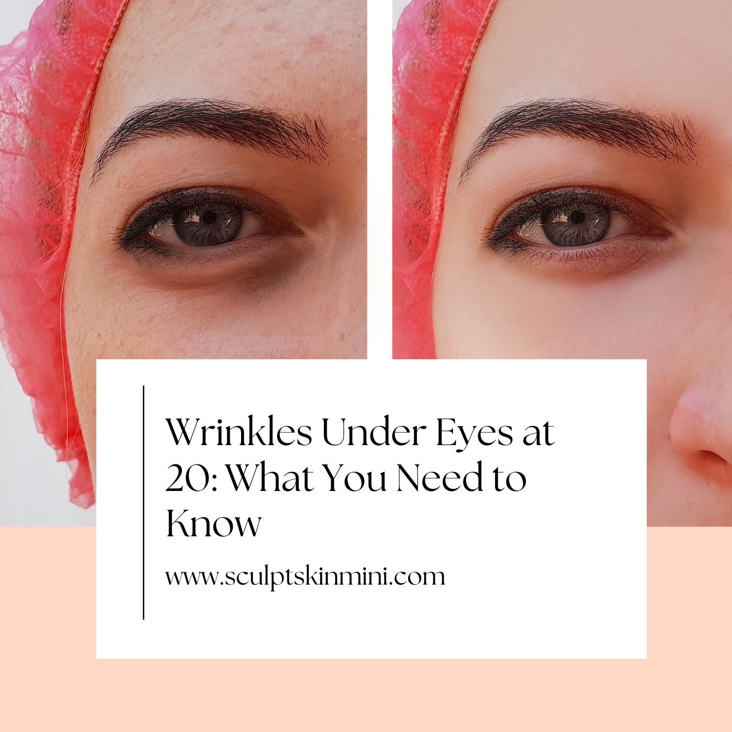 Wrinkles Under Eyes at 20: What You Need to Know – SculptSkin