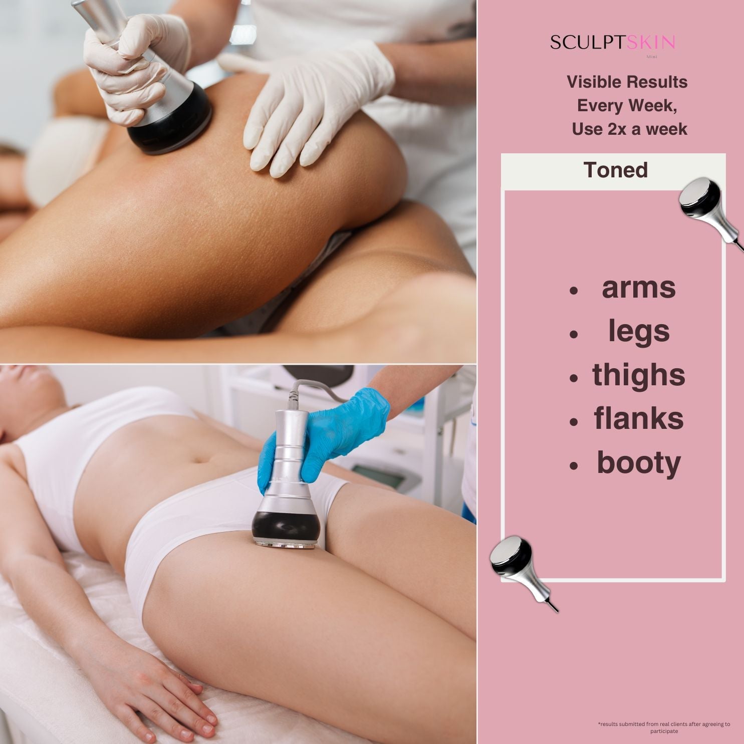 SculptSkin™ Mini 2.0 Body Sculpting - SculptSkin . Achieve body contouring and shaping with Ultrasonic Cavitation, a non-surgical fat reduction treatment. Safe and effective for targeting stubborn areas like the waist, thighs, hips, back, and arms—an ideal alternative to liposuction.